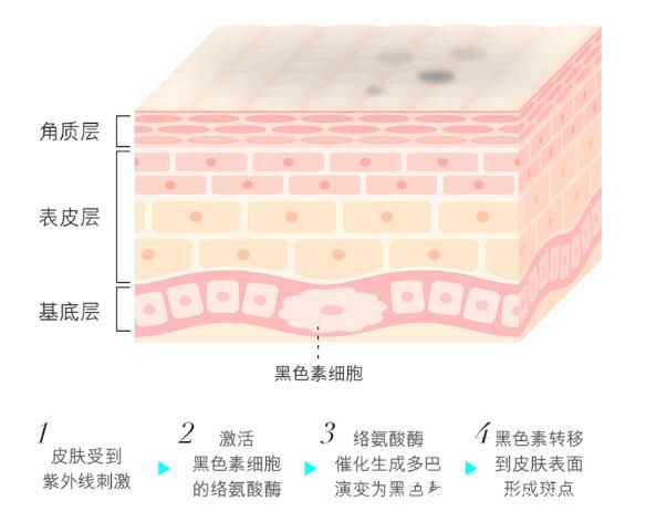 斑點(diǎn)的產(chǎn)生原因