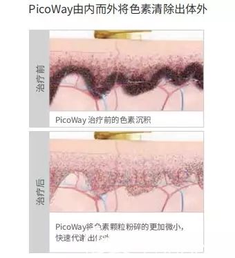 相比于傳統(tǒng)激光，皮秒激光不容易復(fù)發(fā)和反黑