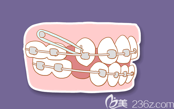 陳聰慧說有些牙合畸形是必須要拔牙的