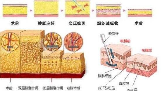 大腿吸脂的手術(shù)原理