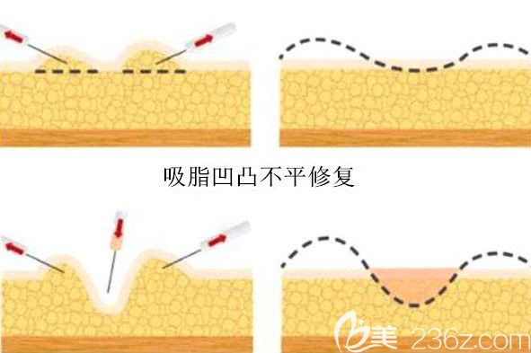 吸脂修復(fù)改善術(shù)后的凹凸不平