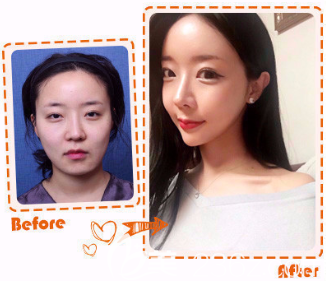 韓國女神整形下頜角整形真人案例