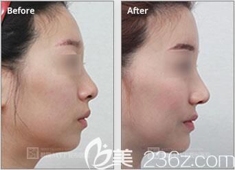 崔寓植院長鼻整形真人<span style=