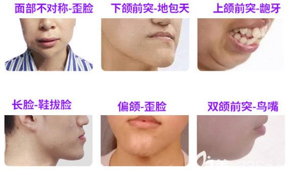 什么人需要做正頜手術 什么人需要做正頜手術