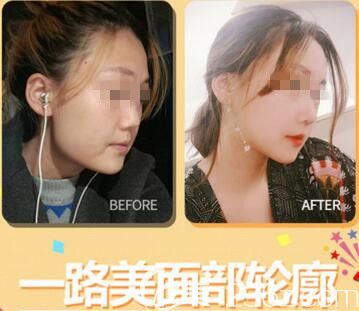 韓國(guó)一路美整形外科面部輪廓整形真人案例