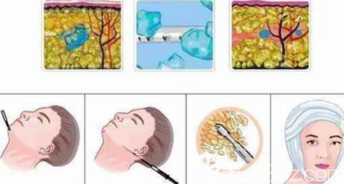 面部吸脂手術(shù)原理示意圖