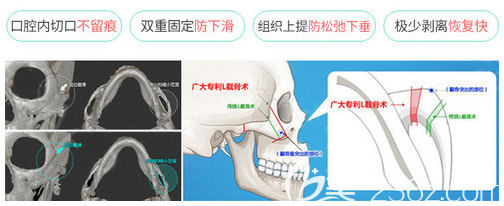 廣州廣大整形醫(yī)院柳超做顴骨顴弓縮小手術(shù)優(yōu)勢(shì)