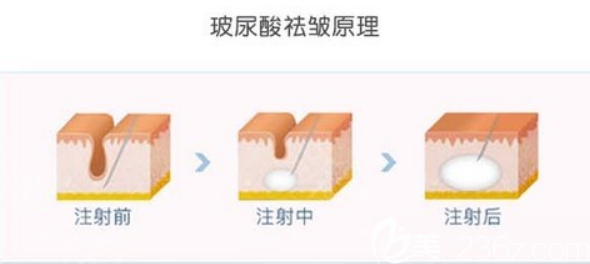 玻尿酸祛皺原理圖