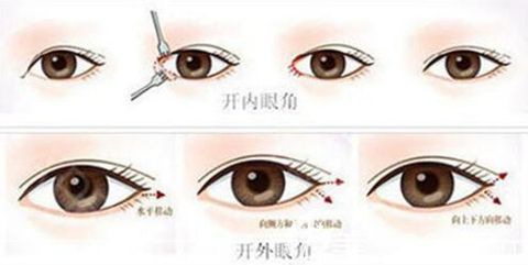 南陽(yáng)艾美眼綜合手術(shù)