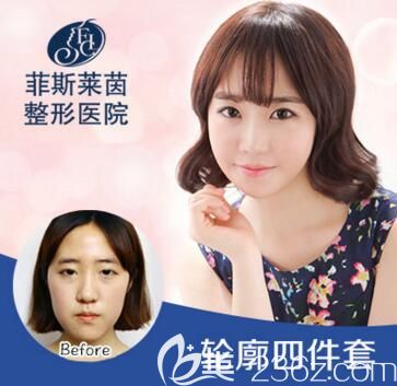 菲斯萊茵李真秀院長輪廓四件套真人前后效果對比