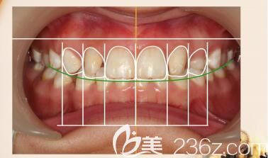 長沙科爾雅口腔陳斌醫(yī)生解答什么是牙齒美學(xué)正畸 長沙科爾雅口腔陳斌醫(yī)生解答什么是牙齒美學(xué)正畸
