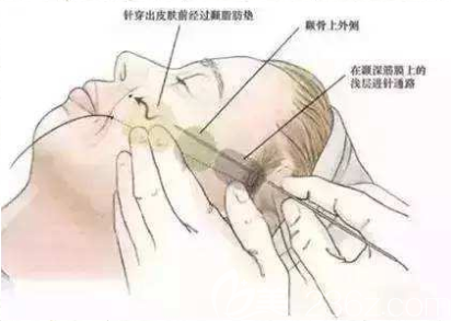 韓國面部提升整形價格貴嗎？