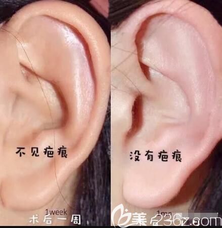 取自體耳軟骨基本上不會留疤 取自體耳軟骨基本上不會留疤