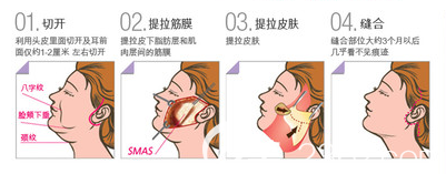 韓國THE整形外科醫(yī)院面部提升手術(shù)示意圖