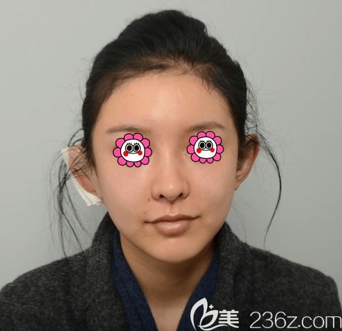 之前在韓國Profile普羅菲耳做面部輪廓手術(shù)還行這次做了貼發(fā)耳矯正術(shù)