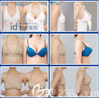 韓國ID醫(yī)院隆胸真人案例