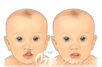 韓國唇裂修復(fù)哪家醫(yī)院好？