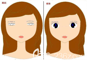 韓國(guó)THE CLINIC雙眼皮修復(fù)特點(diǎn)