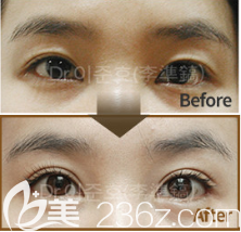 韓國(guó)THE CLINIC雙眼皮修復(fù)真人案例