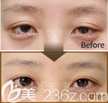 韓國(guó)THE CLINIC雙眼皮修復(fù)真人案例圖2