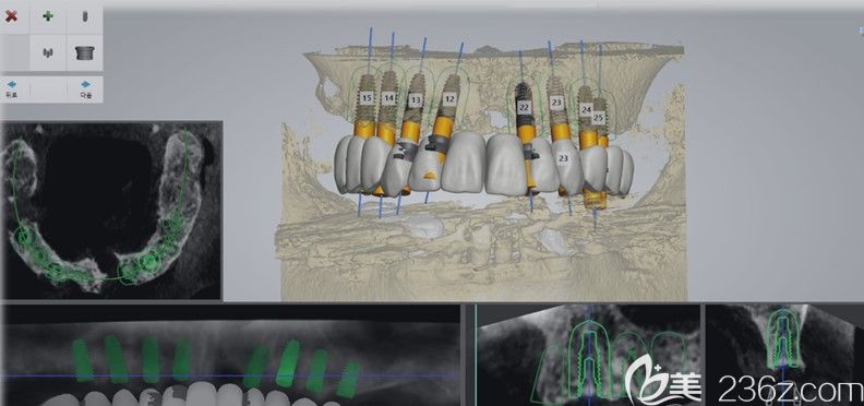 銀川和仁堂的DIOnavi種牙特色技術(shù)術(shù)前準備
