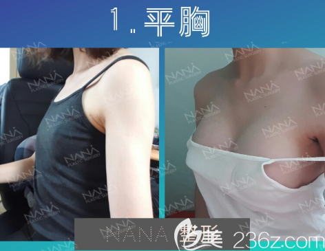 NANA整形外科改善平胸