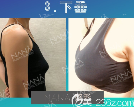 韓國做胸好的醫(yī)院是哪家