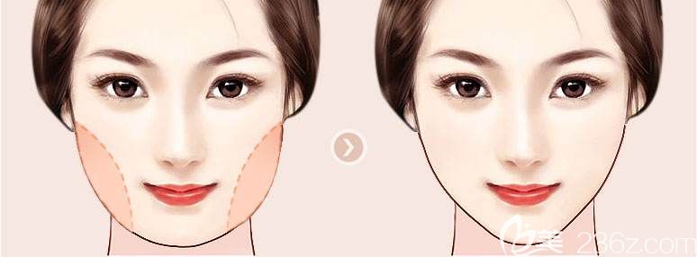 做完面部吸脂前后對(duì)比 做完面部吸脂前后對(duì)比