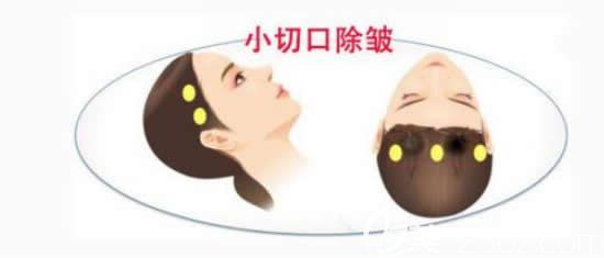 小切口微創(chuàng)除皺手術(shù)操作圖