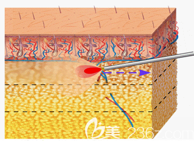 韓國必瘦B醫(yī)院溶脂效果好不好？