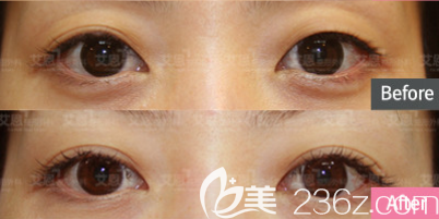 韓國艾恩醫(yī)院雙眼皮失敗修復(fù)