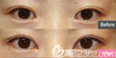 金尹鎬開眼角案例