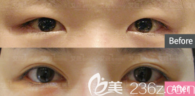 金承俊內(nèi)眥贅皮矯正