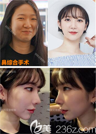 韓國艾恩隆鼻好嗎