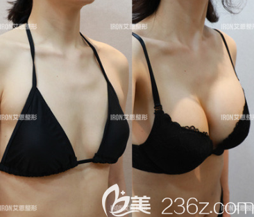 崔源哲假體隆胸案例