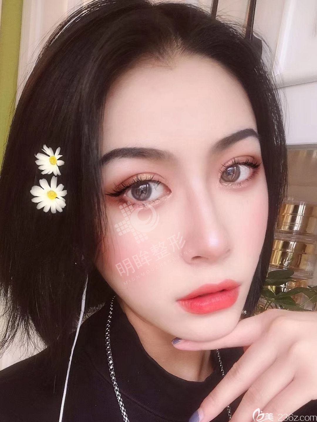 鄭州明眸精雕雙眼皮效果變化照片 你看我年輕了幾歲