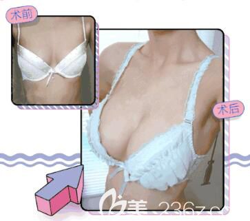 崔淳祐院長魔滴假體隆胸真人前后對比照