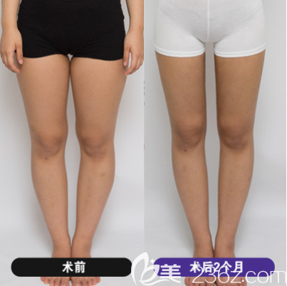 韓國(guó)維摩大腿吸脂怎么樣