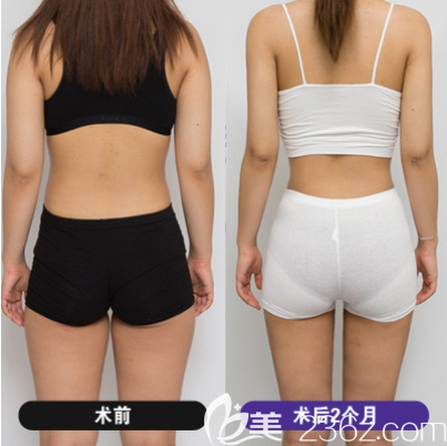 韓國(guó)吸脂醫(yī)院哪個(gè)好