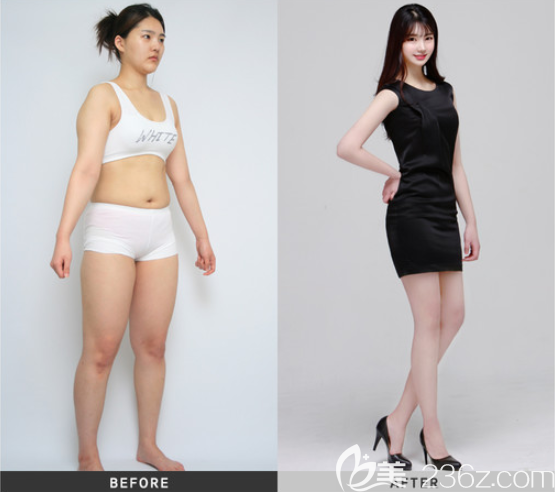 韓國(guó)維摩整形吸脂案例