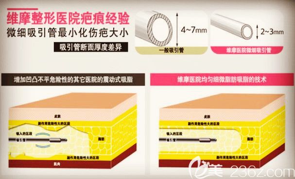 術(shù)后皮膚平滑
