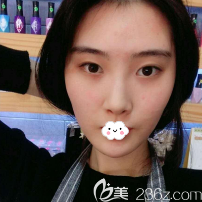 找金孝憲做鼻修復(fù)術(shù)前照片 找金孝憲做鼻修復(fù)術(shù)前照片