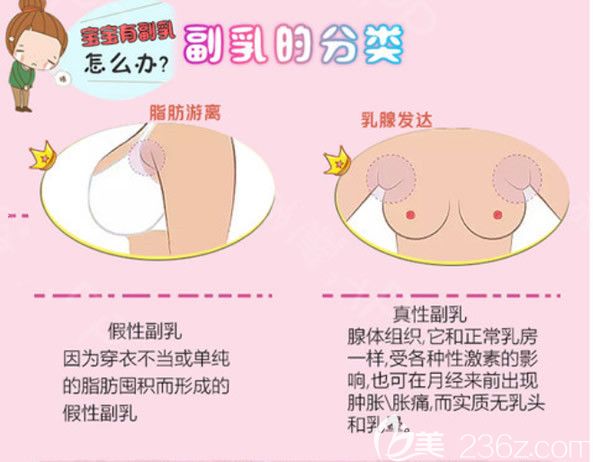 真性副乳假性副乳圖片