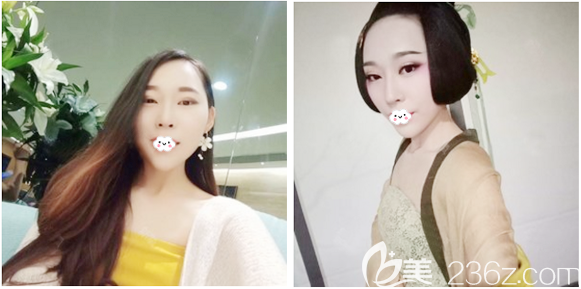 在廣州壹加壹做隆胸術(shù)前照片 在廣州壹加壹做隆胸術(shù)前照片