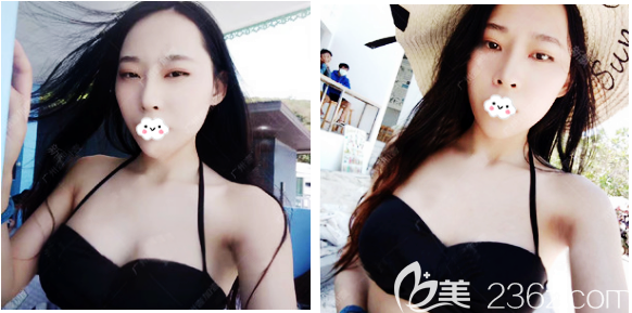 找廣州壹加壹整形醫(yī)院項(xiàng)美蓮做完隆胸后整理了一份假體隆胸價(jià)格表