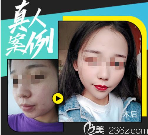 蘭州崔大夫光子嫩膚祛斑效果怎么樣