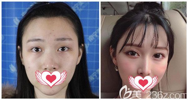 找美麗焦點焦俊光做硅膠假體隆鼻+耳軟骨墊鼻尖前后效果對比圖