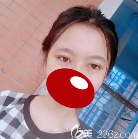 <i data-id='d68550cc-1240-4c94-b9dc-67d5c1c75313' style='display:none;'></i>西華張慧慧為我做雙眼皮術(shù)后10天照片 <i data-id='d68550cc-1240-4c94-b9dc-67d5c1c75313' style='display:none;'></i>西華張慧慧為我做雙眼皮術(shù)后10天照片