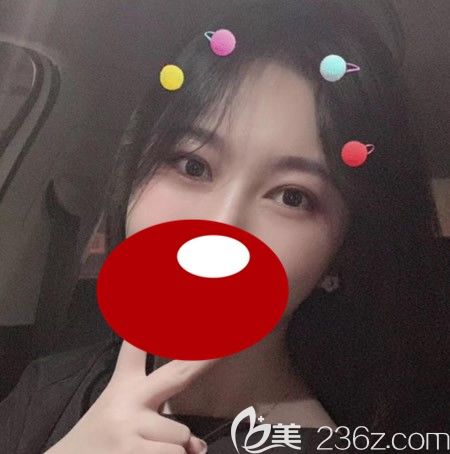 <i data-id='d68550cc-1240-4c94-b9dc-67d5c1c75313' style='display:none;'></i>西華張慧慧為我做雙眼皮術(shù)后40天美圖 <i data-id='d68550cc-1240-4c94-b9dc-67d5c1c75313' style='display:none;'></i>西華張慧慧為我做雙眼皮術(shù)后40天美圖