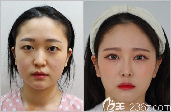 韓國艾恩眼鼻整形案例